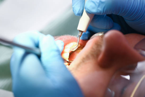 Best Emergency Root Canal Treatment in Winchester, VA